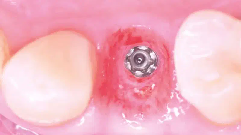 Immediate implant placement using cerabone® +HyA