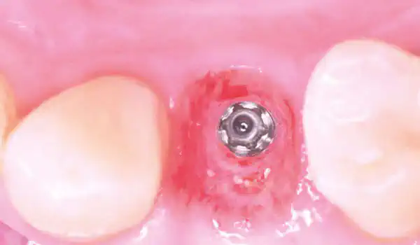 Image for case Immediate implant placement using cerabone® +HyA