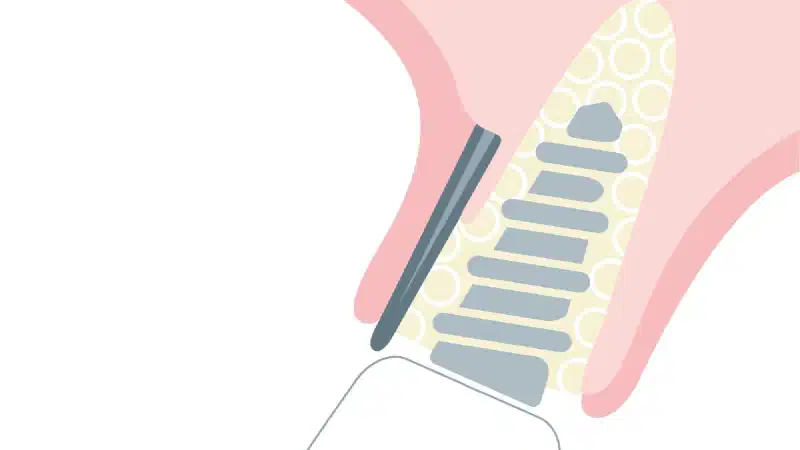 Magnesium membrane shield technique for immediate dentoalveolar bone regeneration