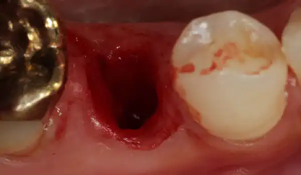 Image for case Socket seal with mucoderm®