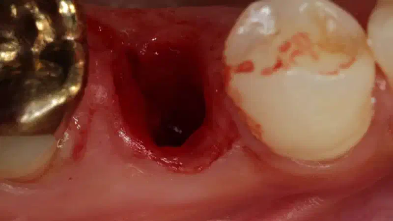 Socket seal with mucoderm®