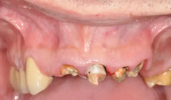 Image for case Ridge preservation with maxgraft®, mucoderm® & Jason® membrane