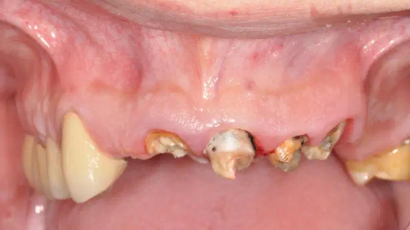 Ridge preservation with maxgraft®, mucoderm® & Jason® membrane