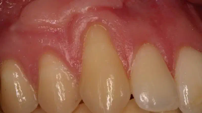 Single gingival recession treated with the envelope technique in conjunction with mucoderm®