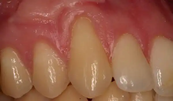 Image for case Single gingival recession treated with the envelope technique in conjunction with mucoderm®