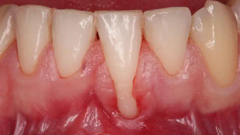 Isolated gingival recession treated with the modified coronally advanced tunnel in conjunction with Straumann® Emdogain® and autologous CTG