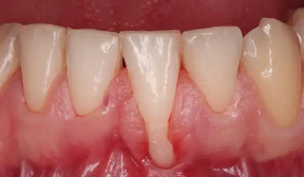 Image for case Isolated gingival recession treated with the modified coronally advanced tunnel in conjunction with Straumann® Emdogain® and autologous CTG