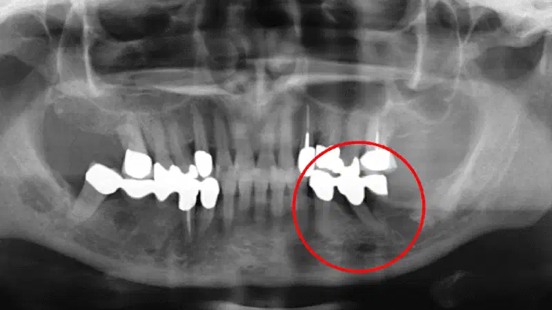 Contained intrabony defect treated using Straumann® Emdogain®