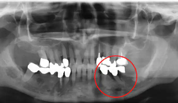 Image for case Contained intrabony defect treated using Straumann® Emdogain®