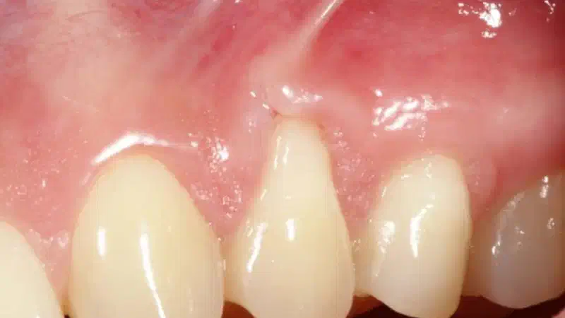 Single gingival recession treated with the coronally advanced flap in conjunction with mucoderm®