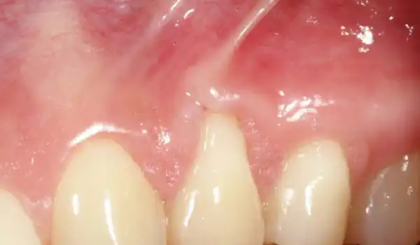 Image for case Single gingival recession treated with the coronally advanced flap in conjunction with mucoderm®