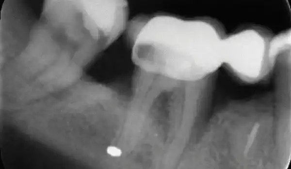 Image for case Intrabony defect treated using Straumann® Emdogain®, cerabone® and Jason® membrane