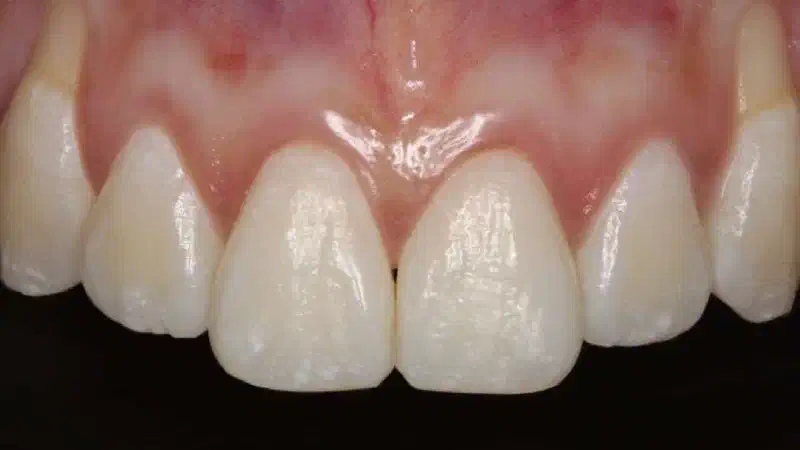 Isolated gingival recessions treated with the coronally advanced flap in conjunction with mucoderm® and Straumann® Emdogain®