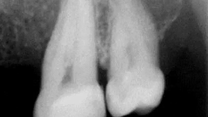 Intrabony defect treated using cerabone® and Straumann® Emdogain®