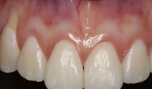 Image for case Isolated gingival recessions treated with the coronally advanced flap in conjunction with mucoderm® and Straumann® Emdogain®