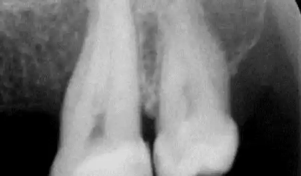 Image for case Intrabony defect treated using cerabone® and Straumann® Emdogain®