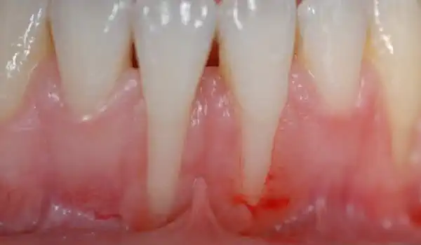 Image for case Multiple gingival recessions treated with the modified coronally advanced tunnel in conjunction with Straumann® Emdogain® and autologous CTG