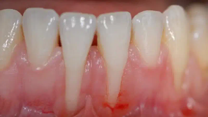 Multiple gingival recessions treated with the modified coronally advanced tunnel in conjunction with Straumann® Emdogain® and autologous CTG