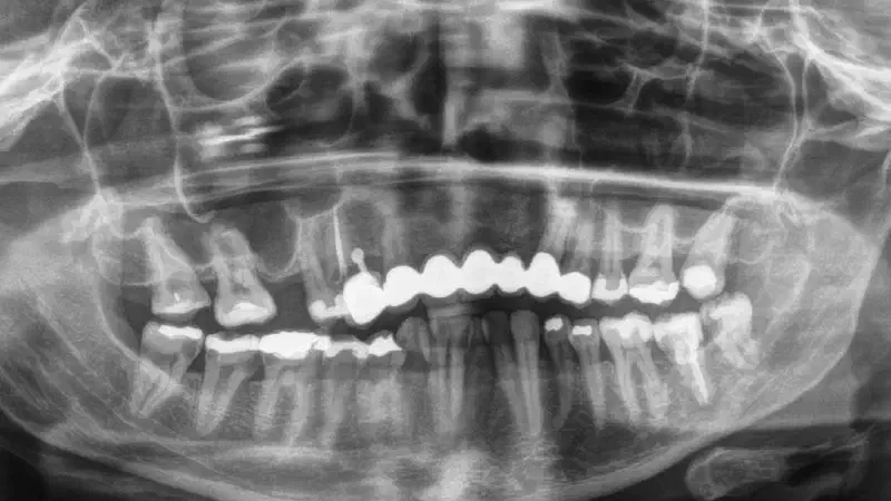 Sinus floor elevation with maxgraft® bonering