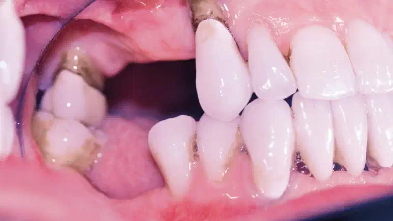 Ridge augmentation with maxgraft® bonebuilder and sinus floor elevation