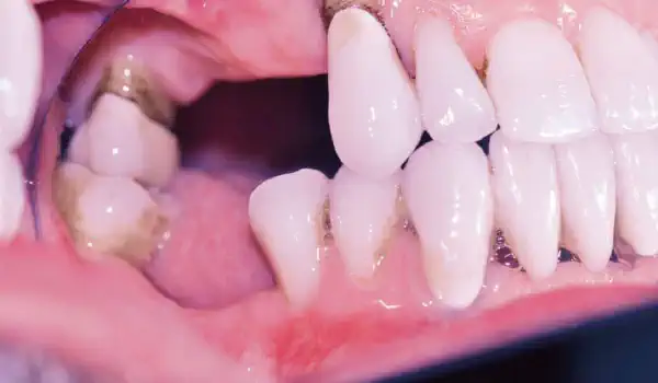 Image for case Ridge augmentation with maxgraft® bonebuilder and sinus floor elevation