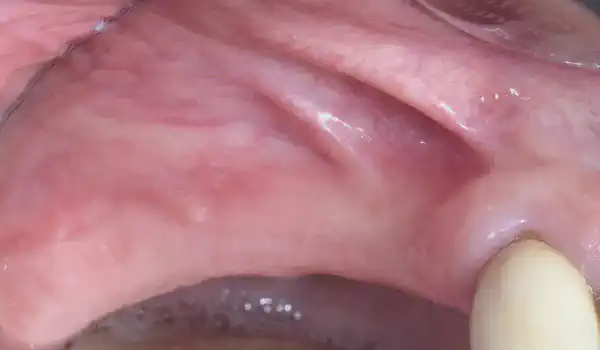 Image for case GBR with Jason® membrane and cerabone®
