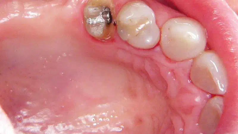 Two-stage sinus floor elevation and horizontal GBR using cerabone®, autologous bone and Jason® membrane