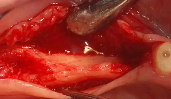Image for case GBR with cerabone® & collprotect® membrane
