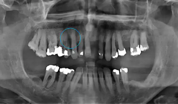 Image for case Non-contained intrabony defect treated using cerabone®, collprotect® membrane and Straumann® Emdogain®