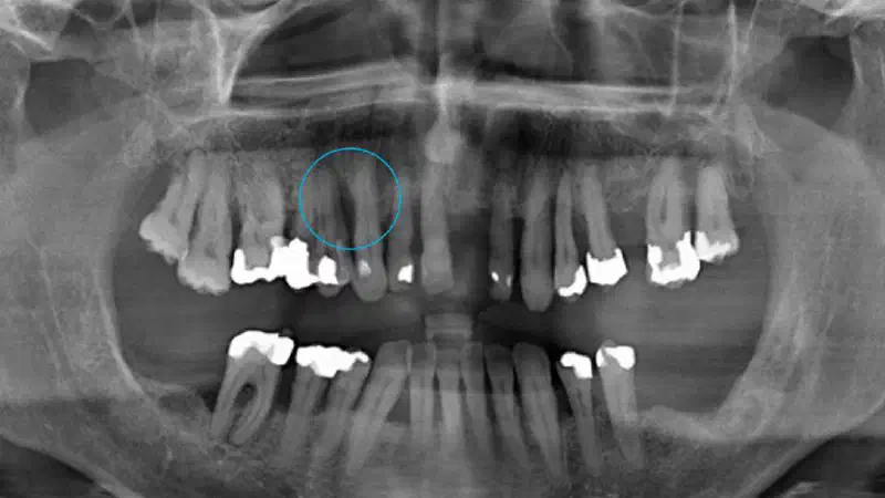 Non-contained intrabony defect treated using cerabone®, collprotect® membrane and Straumann® Emdogain®