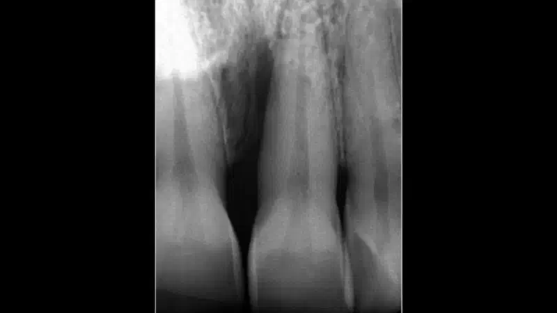 Non-contained intrabony defect treated using cerabone®, collprotect® membrane and Straumann® Emdogain® (2)