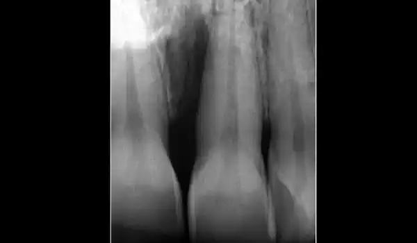 Image for case Non-contained intrabony defect treated using cerabone®, collprotect® membrane and Straumann® Emdogain® (2)