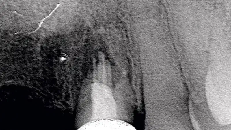 Socket preservation using cerabone® and Straumann® Emdogain®