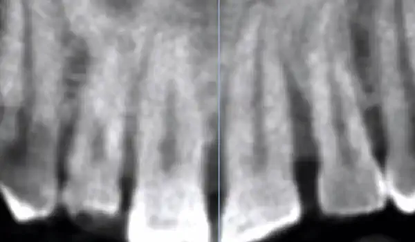 Image for case Immediate implant placement using cerabone® and collagen fleece