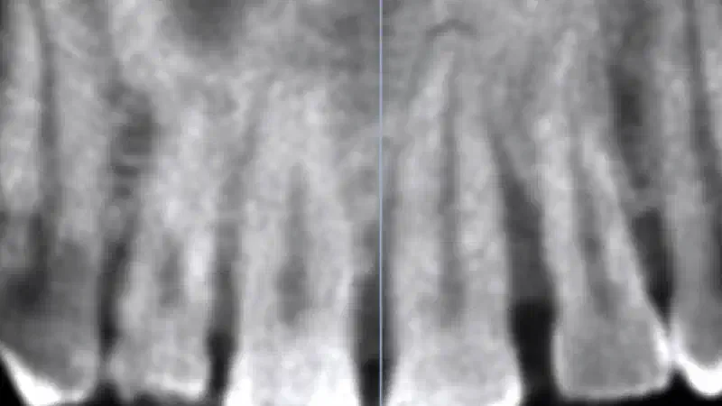 Immediate implant placement using cerabone® and collagen fleece