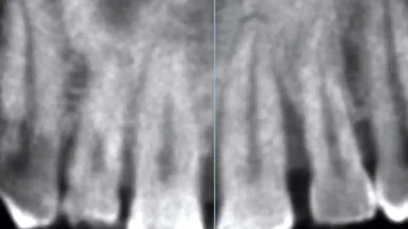 Immediate implantation with cerabone® & collagen fleece