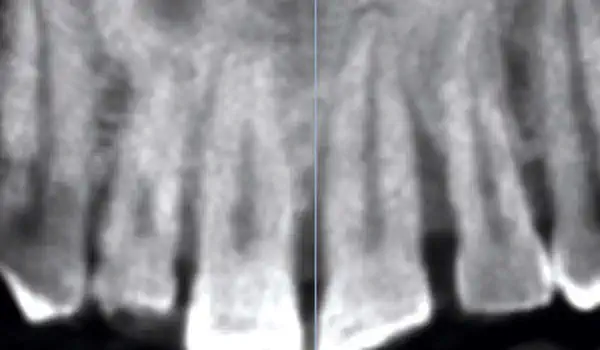 Image for case Immediate implantation with cerabone® & collagen fleece