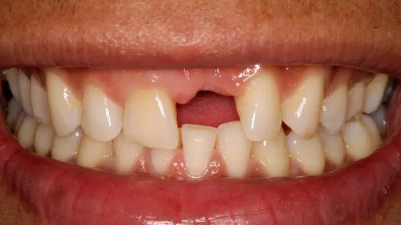Block augmentation with cerabone®, Jason® membrane & autologous bone blocks