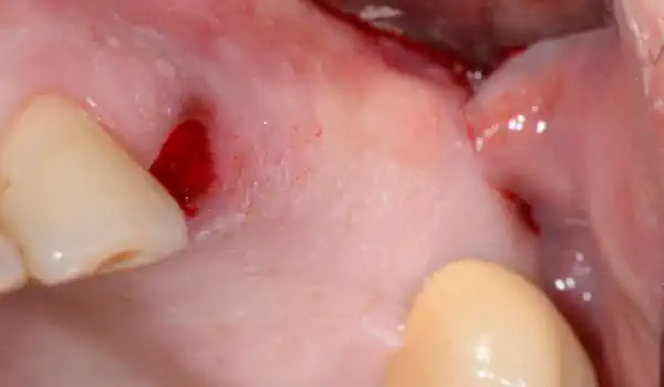 Image for case Two-stage sinus lift with cerabone®, Jason® membrane & collagen fleece