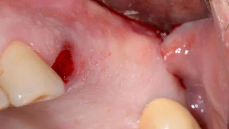 Two-stage sinus lift with cerabone®, Jason® membrane & collagen fleece