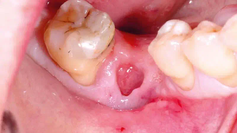 Bone defect augmentation in the lower jaw using autologous bone, cerabone® and permamem®