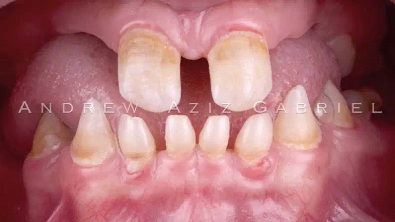 Horizontal/vertical GBR using cerabone®/maxgraft®, Jason® membrane/collprotect® membrane and Ti-mesh