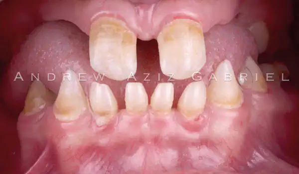 Image for case Horizontal/vertical GBR using cerabone®/maxgraft®, Jason® membrane/collprotect® membrane and Ti-mesh