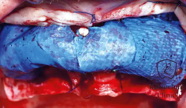 Image for case GBR of the edentulous maxillary ridge using permamem®, cerabone® and autologous bone chips