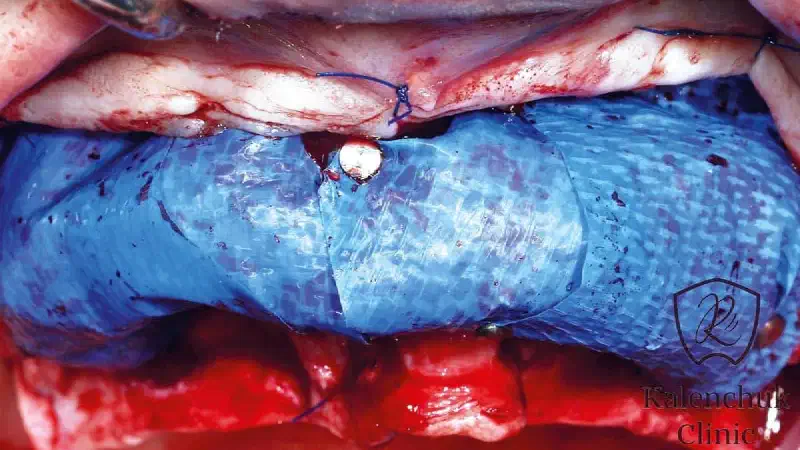 GBR of the edentulous maxillary ridge using permamem®, cerabone® and autologous bone chips
