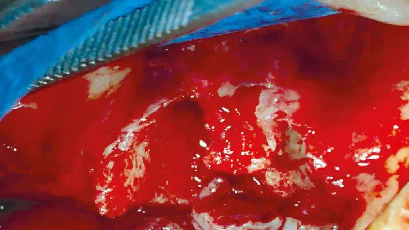 Bone defect augmentation in the upper jaw using autologous bone, cerabone® and permamem®