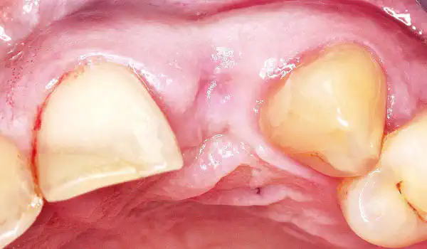 Image for case Implant placement and bone augmentation in the aesthetic zone