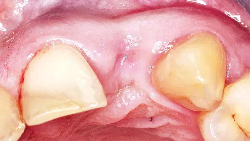 Implant placement and bone augmentation in the aesthetic zone
