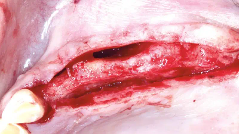 Extended horizontal ridge augmentation using autologous bone, cerabone® and permamem®