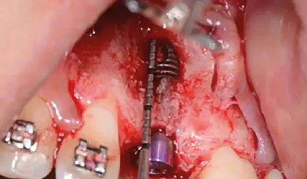 Image for case Treatment of an implant dehiscence using cerabone® and permamem®